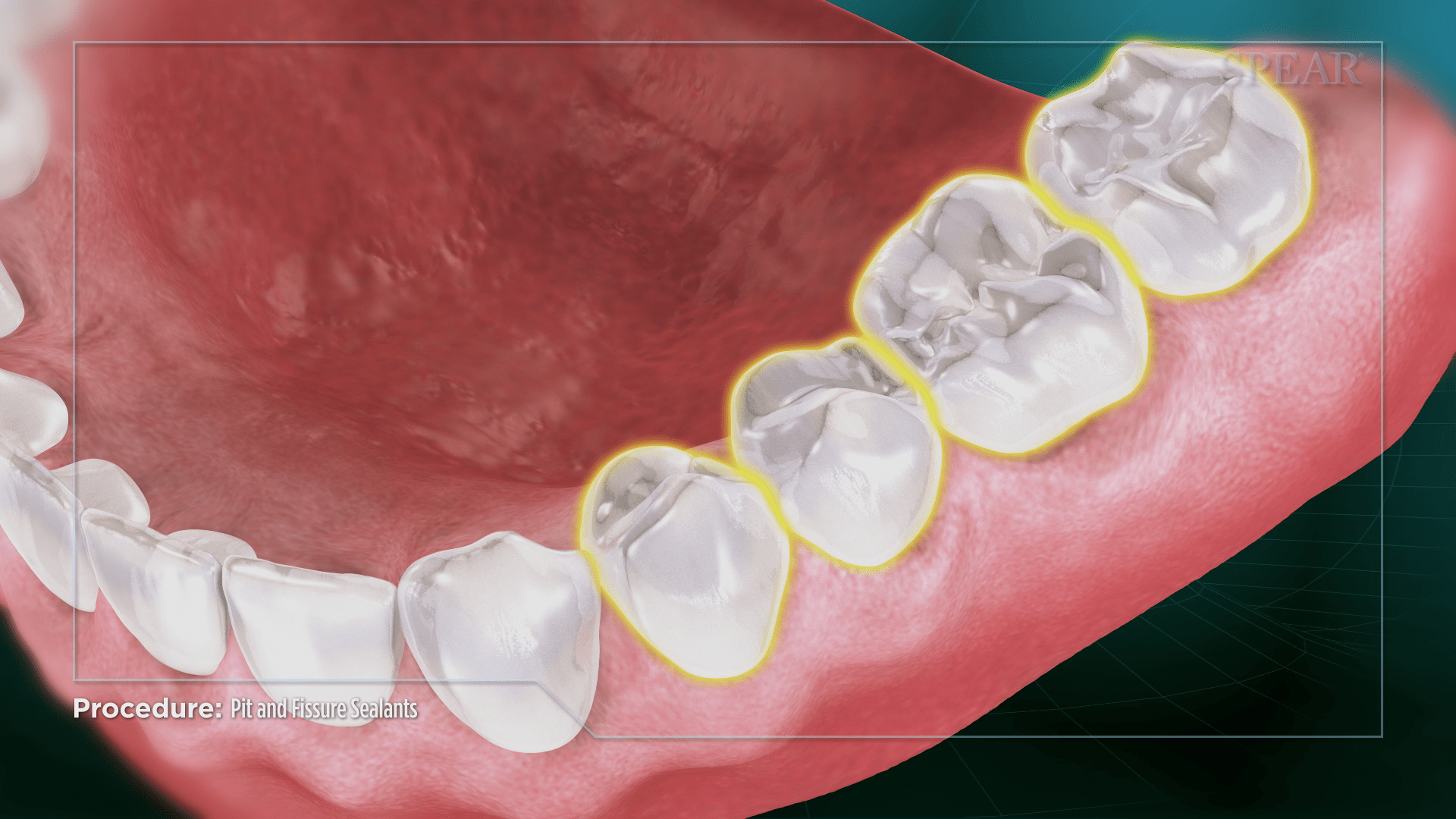 Dental Evaluation For Sealants