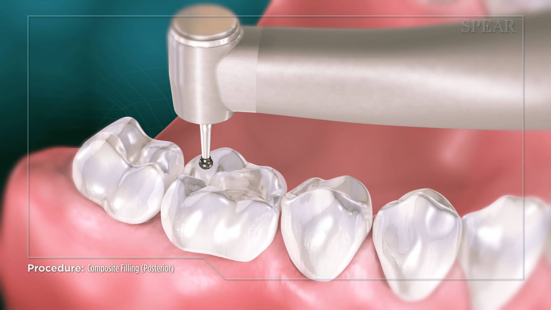 Decayed Portion Removal at Cambridge Dental Associates
