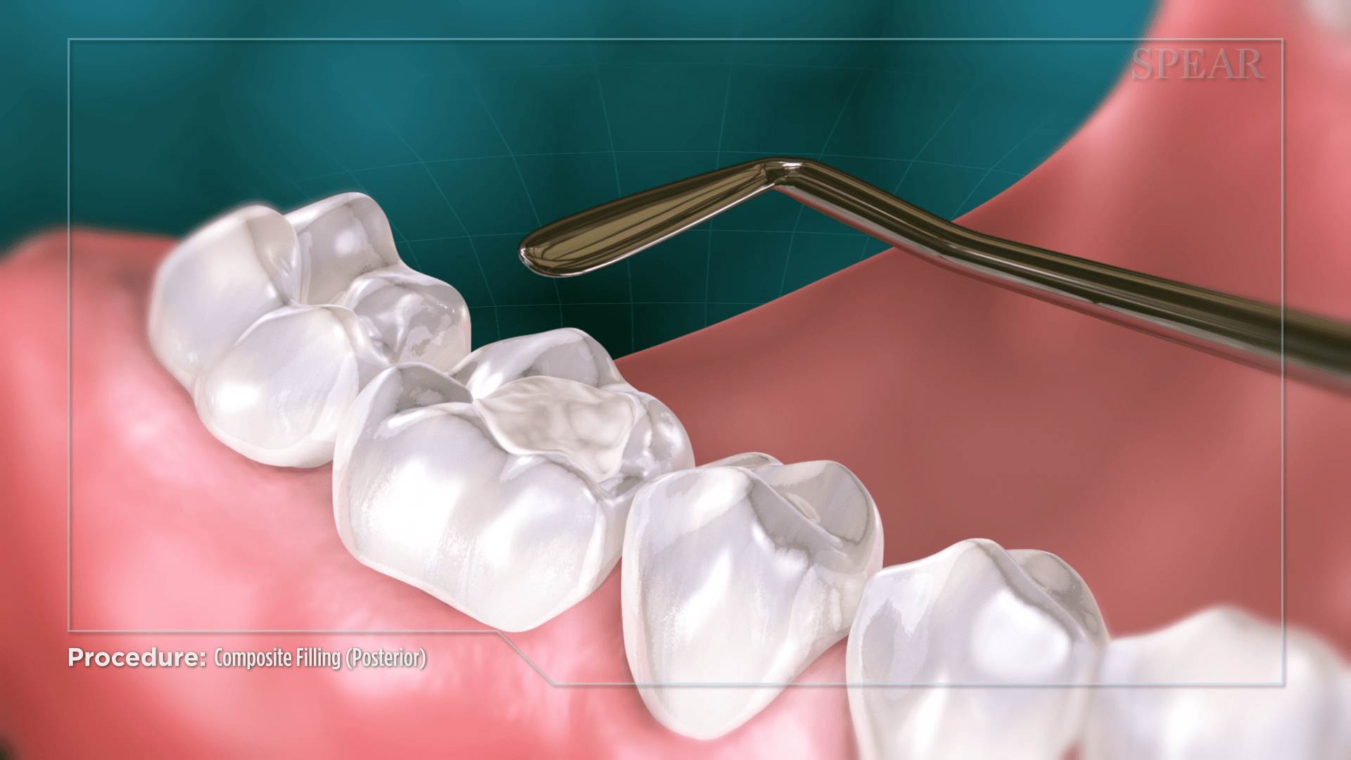 Contour Shaping of Tooth Area at Cambridge Dental Associates