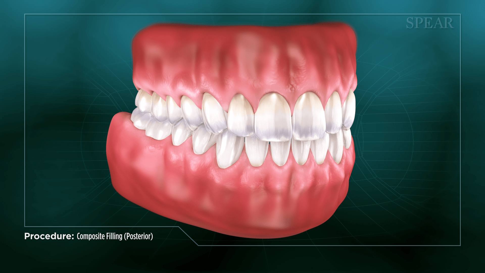 Composite Filled Teeth at Cambridge Dental Associates