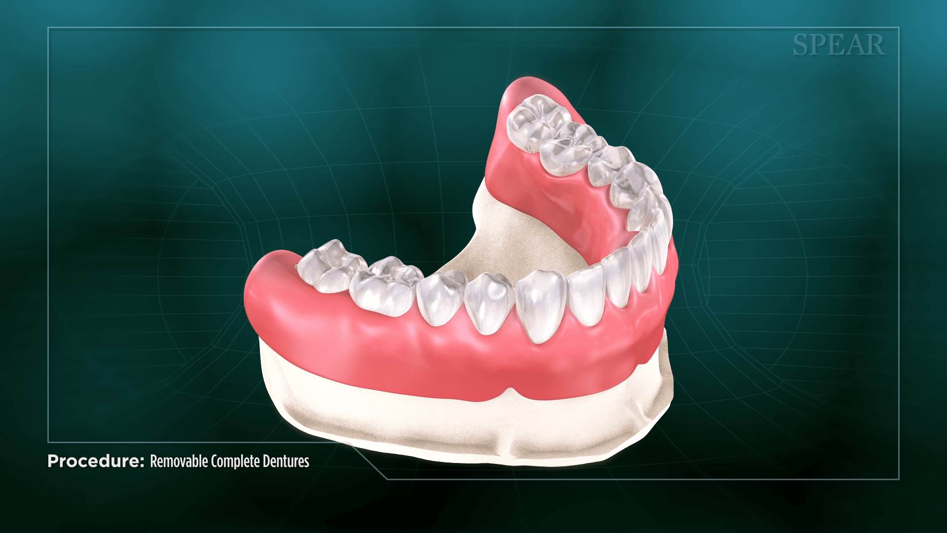 Mouth Prosthesis Design at Cambridge Dental Associates
